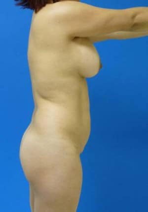 Brazilian Butt Lift before, case 1069, side view (Female, 35: BBL (700 cc per side))