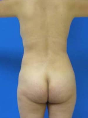 Brazilian Butt Lift before, case 1067, back view (Female, 40: BBL (600 cc per side))