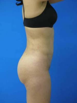 Brazilian Butt Lift after, case 1067, side view (Female, 40: BBL (600 cc per side))