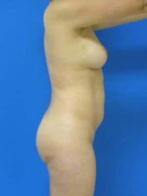 Brazilian Butt Lift before, case 1067, side view (Female, 40: BBL (600 cc per side))