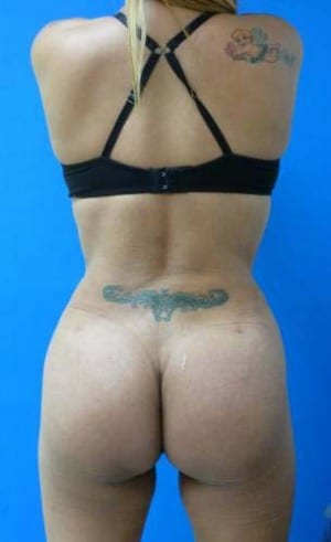 Brazilian Butt Lift after, case 1065, back view (Female, 33: BBL (750 cc per side))