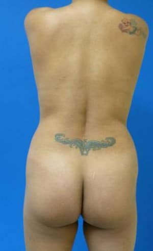 Brazilian Butt Lift before, case 1065, back view (Female, 33: BBL (750 cc per side))
