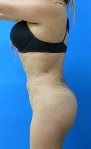 Brazilian Butt Lift after, case 1065, side view (Female, 33: BBL (750 cc per side))