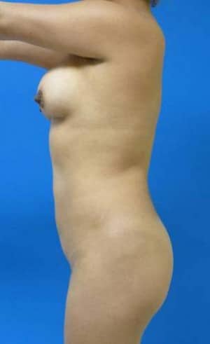 Brazilian Butt Lift before, case 1065, side view (Female, 33: BBL (750 cc per side))