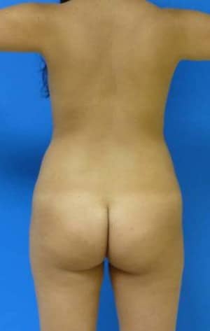 Brazilian Butt Lift before, case 1066, back view (Female, 22: BBL (600 cc per side))