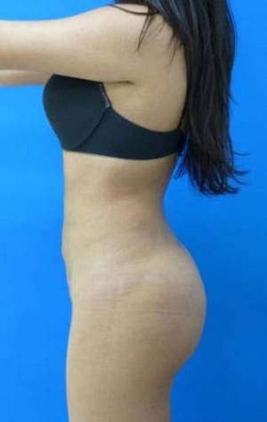 Brazilian Butt Lift after, case 1066, side view (Female, 22: BBL (600 cc per side))
