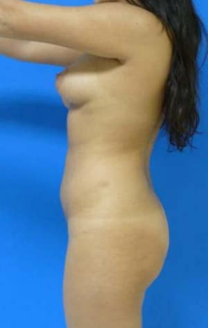 Brazilian Butt Lift before, case 1066, side view (Female, 22: BBL (600 cc per side))