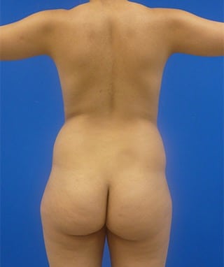 Brazilian Butt Lift before, case 1091, front view (Female, 31: BBL (1,000 cc per side))
