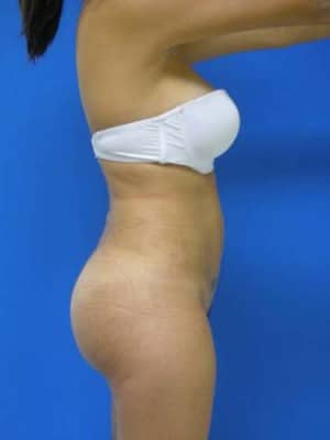 Brazilian Butt Lift after, case 1064, side view (Female, 25: BBL (750 cc per side))