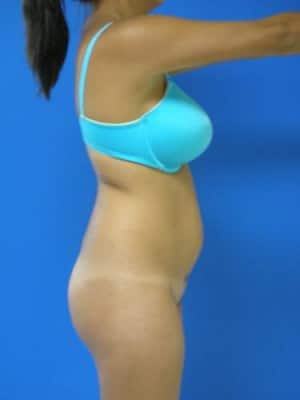 Brazilian Butt Lift before, case 1064, side view (Female, 25: BBL (750 cc per side))