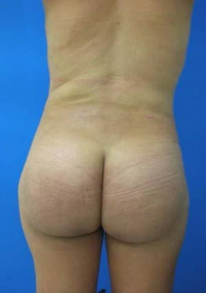 Brazilian Butt Lift after, case 1063, back view (Female, 35: BBL (800 cc per side))