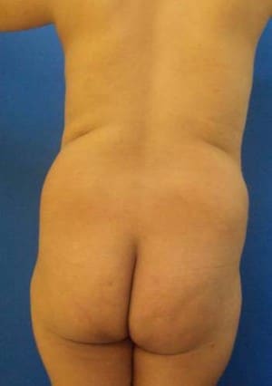 Brazilian Butt Lift before, case 1063, back view (Female, 35: BBL (800 cc per side))