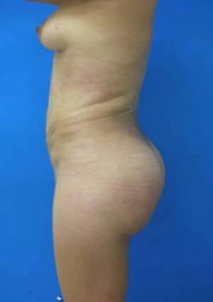 Brazilian Butt Lift after, case 1063, side view (Female, 35: BBL (800 cc per side))