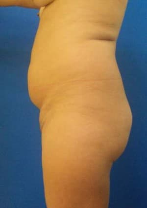 Brazilian Butt Lift before, case 1063, side view (Female, 35: BBL (800 cc per side))