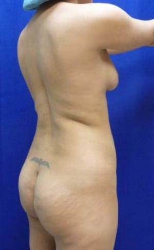Brazilian Butt Lift before, case 1062, angle view (Female, 30: BBL (650 cc per side))