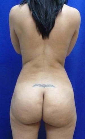 Brazilian Butt Lift after, case 1062, back view (Female, 30: BBL (650 cc per side))