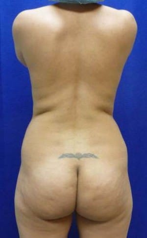 Brazilian Butt Lift before, case 1062, back view (Female, 30: BBL (650 cc per side))