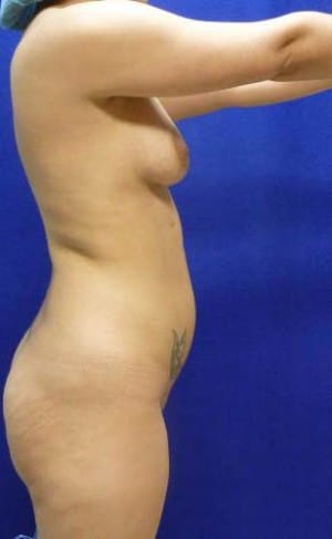 Brazilian Butt Lift before, case 1062, side view (Female, 30: BBL (650 cc per side))