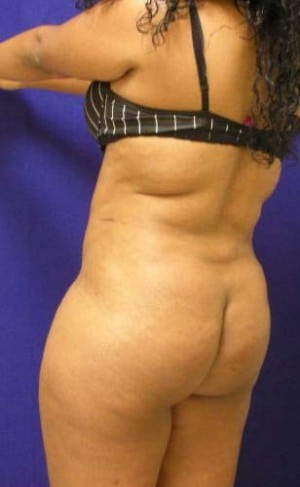 Brazilian Butt Lift before, case 1061, angle view (Female, 25: BBL (750 cc per side))