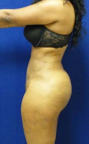 Brazilian Butt Lift after, case 1061, side view (Female, 25: BBL (750 cc per side))
