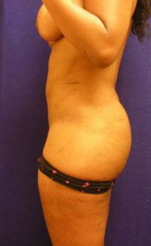 Brazilian Butt Lift before, case 1061, side view (Female, 25: BBL (750 cc per side))