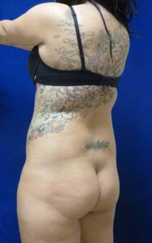 Brazilian Butt Lift before, case 1060, back view (Female, 25: BBL (960 cc per side))