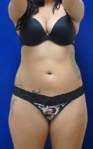Brazilian Butt Lift before, case 1060, front view (Female, 25: BBL (960 cc per side))