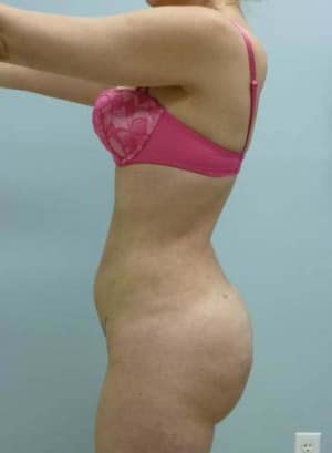 Brazilian Butt Lift after, case 1059, angle view (Female, 30: BBL (950 cc per side))