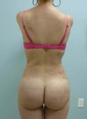 Brazilian Butt Lift after, case 1059, back view (Female, 30: BBL (950 cc per side))