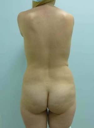 Brazilian Butt Lift before, case 1059, back view (Female, 30: BBL (950 cc per side))
