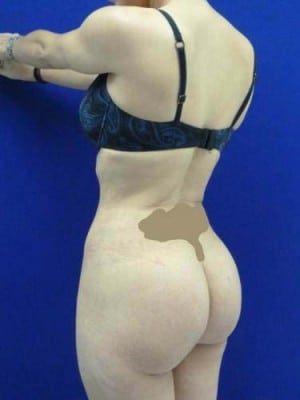 Brazilian Butt Lift after, case 1058, angle view (Female, 30: BBL (750 cc per side))