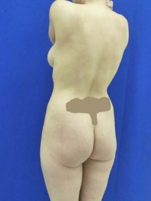 Brazilian Butt Lift before, case 1058, angle view (Female, 30: BBL (750 cc per side))
