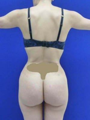 Brazilian Butt Lift after, case 1058, back view (Female, 30: BBL (750 cc per side))