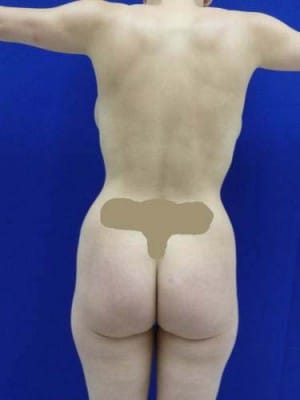 Brazilian Butt Lift before, case 1058, back view (Female, 30: BBL (750 cc per side))