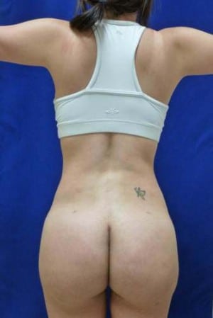 Brazilian Butt Lift after, case 1057, back view (Female, 25: BBL (1,000 cc per side))