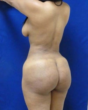 Brazilian Butt Lift after, case 1056, angle view (Female, 31: BBL (1,100 cc per side))