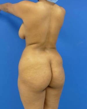 Brazilian Butt Lift before, case 1056, angle view (Female, 31: BBL (1,100 cc per side))