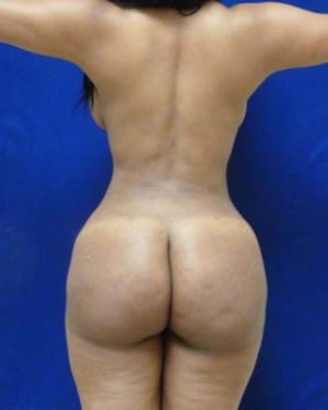 Brazilian Butt Lift after, case 1056, back view (Female, 31: BBL (1,100 cc per side))
