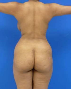 Brazilian Butt Lift before, case 1056, back view (Female, 31: BBL (1,100 cc per side))