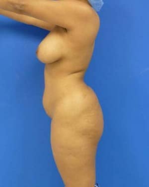 Brazilian Butt Lift before, case 1056, side view (Female, 31: BBL (1,100 cc per side))
