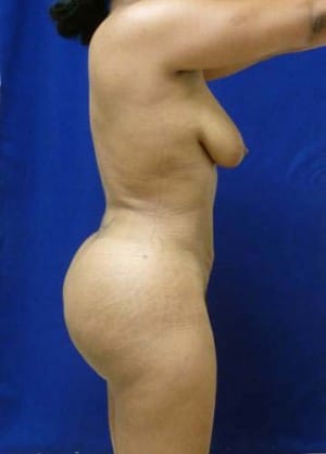 Brazilian Butt Lift after, case 1055, angle view (Female, 26: BBL (1,200 cc per side))