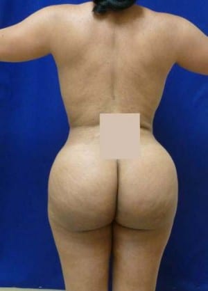 Brazilian Butt Lift after, case 1055, back view (Female, 26: BBL (1,200 cc per side))