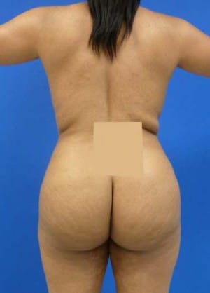 Brazilian Butt Lift before, case 1055, back view (Female, 26: BBL (1,200 cc per side))