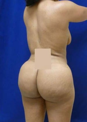 Brazilian Butt Lift after, case 1055, side view (Female, 26: BBL (1,200 cc per side))