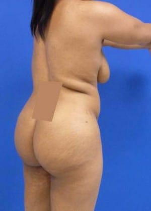 Brazilian Butt Lift before, case 1055, side view (Female, 26: BBL (1,200 cc per side))