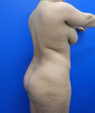 Brazilian Butt Lift before, case 1090, oblique view (Female, 30: BBL (1,500 cc per side))