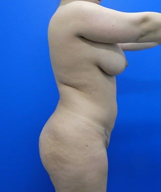 Brazilian Butt Lift before, case 1090, side view (Female, 30: BBL (1,500 cc per side))