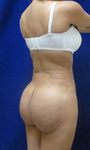 Brazilian Butt Lift after, case 1054, angle view (Female, 25: BBL (1,300 cc per side))