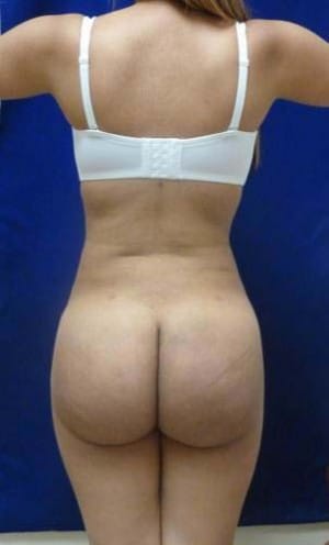 Brazilian Butt Lift after, case 1054, back view (Female, 25: BBL (1,300 cc per side))
