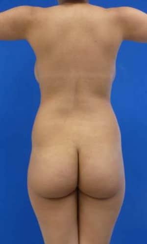 Brazilian Butt Lift before, case 1054, back view (Female, 25: BBL (1,300 cc per side))